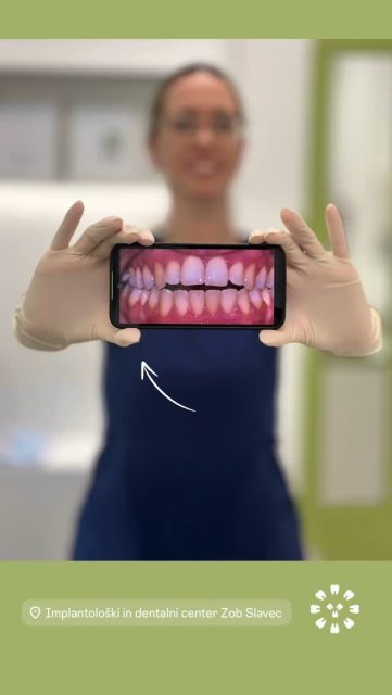 Rezultati z nevidnimi zobnimi aparati so res izjemni, izboljšajo funkcijo in estetiko na neboleč, enostaven in hiter način.#dentistry #zobslavec #healthysmiles #oralhygiene #aligners #alignerstreatment