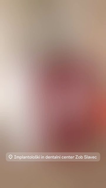 🦷 Vaš nasmeh si zasluži le najboljše!
Ste vedeli, da v Dentalnem in implantološkem centru Zob Slavec že več kot 30 let prisegamo na vrhunsko kakovost? 🌟 Pri nas ne sklepamo kompromisov, ko gre za vaše zdravje in samozavest.Zakaj za nadomeščanje zob izbrati prav nas in znamko Nobel Biocare?
• Tradicija in zaupanje: Že tri desetletja ostajamo zvesti znamki, ki velja za pionirja in svetovnega vodjo v implantologiji.
• Vrhunska kakovost: Nobel Biocare vsadki so sinonim za trajnost, biokompatibilnost in naraven videz.
• Rešitev za vsakogar: Z zobnimi vsadki lahko nadomestimo:
• Single 🦷 – en sam izgubljen zob, brez brušenja sosednjih zob.
• Mostiček na implantatih – več zaporednih manjkajočih zob.
• Popolna rekonstrukcija – vse zobe ene ali obeh čeljusti (npr. koncept All-on-4).
Povrnite si funkcionalnost, varen ugriz in tisti pravi, sproščen nasmeh! 😁#dentistry #zobslavec #oralhygiene #nobelbiocare #oralsurgery